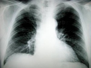 lung cancer